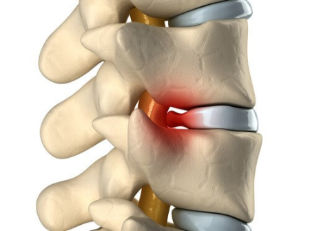 خشکی دیسک کمر, خشکی دیسک و فتق دیسک