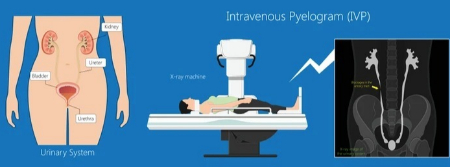 پیلوگرام داخل وریدی (IVP) چیست و چگونه انجام می‌شود؟