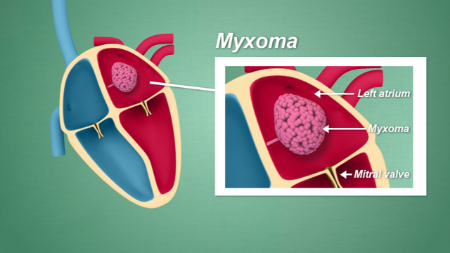 تومور نادر قلبی؛ آیا میگزوم قلبی زندگی را تهدید می‌کند؟