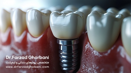چرا ایمپلنت دندانی بهترین راهکار برای جایگزینی دندان‌های از دست‌رفته است؟