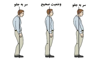 ناهنجاری سر به جلو و حرکات اصلاحی (+عکس)