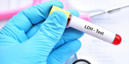 همه‌چیز درباره آزمایش LDH و نقش آن در تشخیص بیماری‌ها