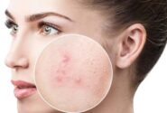 دلیل جوش زدن بعد از استفاده از سرم ویتامین سی چیست؟