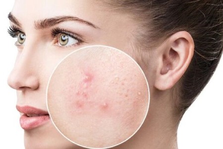 دلیل جوش زدن بعد از استفاده از سرم ویتامین سی چیست؟