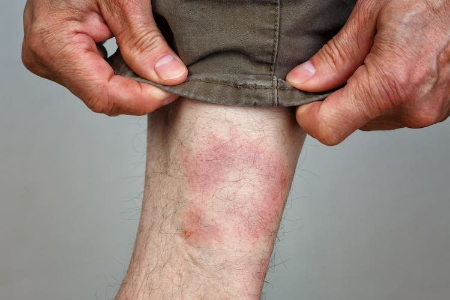 بیماری منتقله توسط کنه, پیشگیری از گزش کنه
