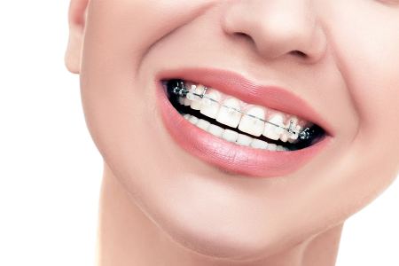 جدیدترین روش های ارتودنسی که باید بشناسید