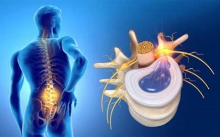 دیسک کمر را چگونه میتوان درمان کرد؟