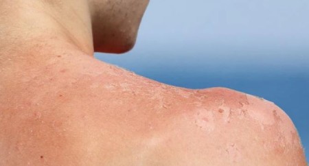چگونه از پوسته پوسته شدن پوست آفتاب سوخته خلاص شویم؟
