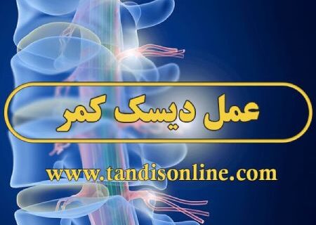 عمل دیسک کمر – اطلاعات کامل درباره دیسک کمر که باید بدانیم