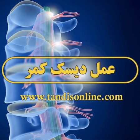 عمل دیسک کمر – اطلاعات کامل درباره دیسک کمر که باید بدانیم