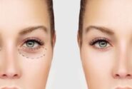 چگونه برای انجام عمل بلفاروپلاستی آماده شویم؟