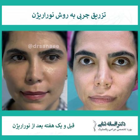عکس تزریق چربی به صورت به روش نوراریژن و نتیجه چشمگیر آن در جوانسازی و زیبایی صورت