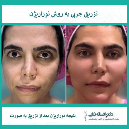 تصویر صورت بعد از تزریق چربی به روش نوراریژن - جوانسازی و زیبایی