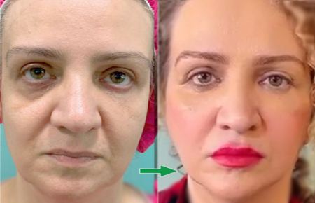 تصویر قبل و بعد از تزریق چربی به روش نوراریژن