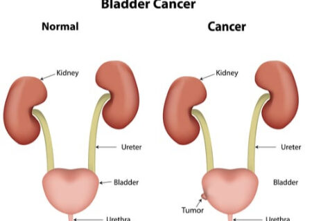 سرطان مجاری ادراری؛ علل، علائم و راه‌های پیشگیری