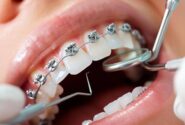 ارتودنسی فقط برای زیبایی نیست؛ نگاهی به فواید پنهان آن