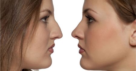 قبل و بعد از عمل بینی