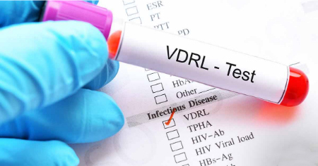 آزمایش VDRL چیست؟ هر آنچه باید درباره تست سیفلیس بدانید