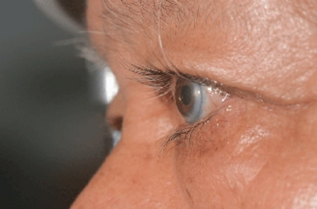 آرکوس سنیلیس, حلقه سفید دور قرنیه