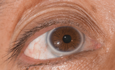 آرکوس سنیلیس, حلقه سفید دور قرنیه