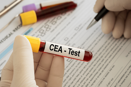 همه‌چیز درباره آزمایش CEA؛ از تشخیص تا پایش درمان