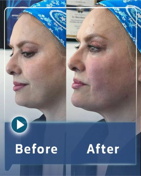 عکس قبل و بعد از کانتورینگ صورت با فیلر