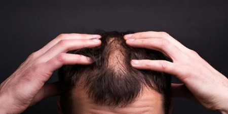 آیا کاشت مو برای بیماران خاص، قلبی، هورمونی و پوستی درست است؟