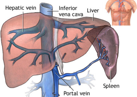 ترومبوز ورید کبدی یا سندرم بود کیاری؛ تهدیدی خاموش برای سلامت کبد