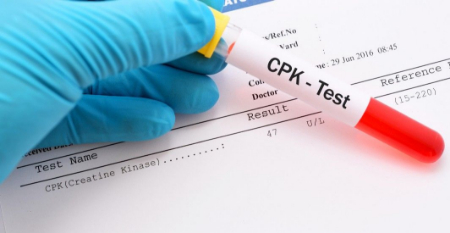 آشنایی با آزمایش CPK: کلیدی برای تشخیص آسیب‌های عضلانی