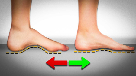 ورزش‌های اصلاحی, ناهنجاری‌های کف پا, صافی کف پا