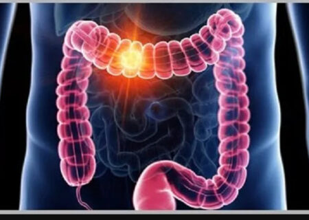 پیشگیری از سرطان روده بزرگ با راهکاری ساده